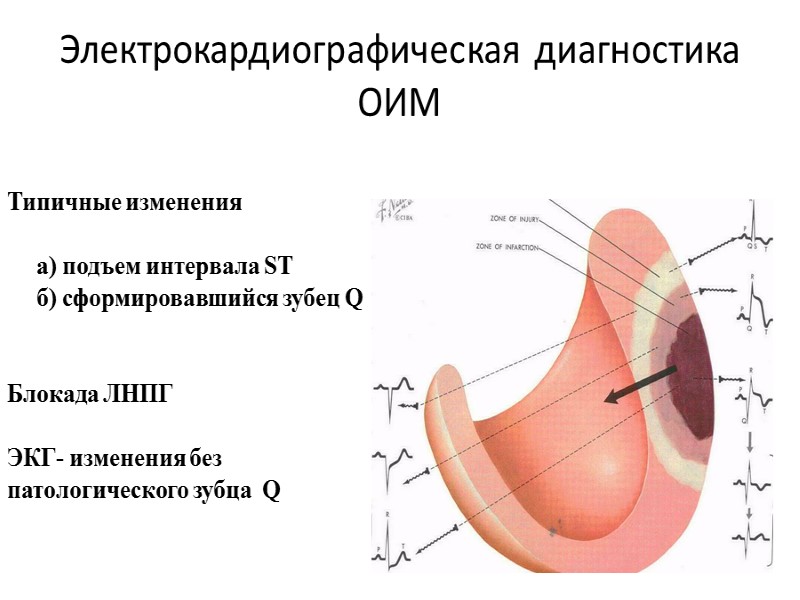 Электрокардиографическая диагностика ОИМ Типичные изменения       а) подъем интервала